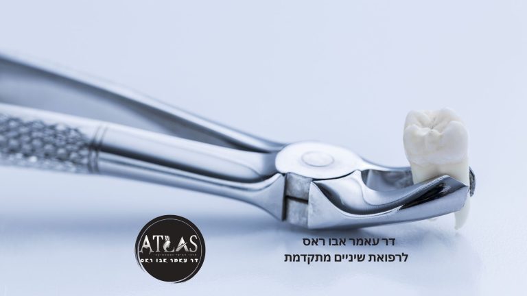 עקירת שן בינה