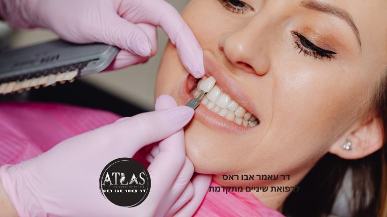 ✨ ציפויי EMAX לשיניים
